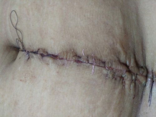 Tahi .. okay Lang po ba yung tahi ko?