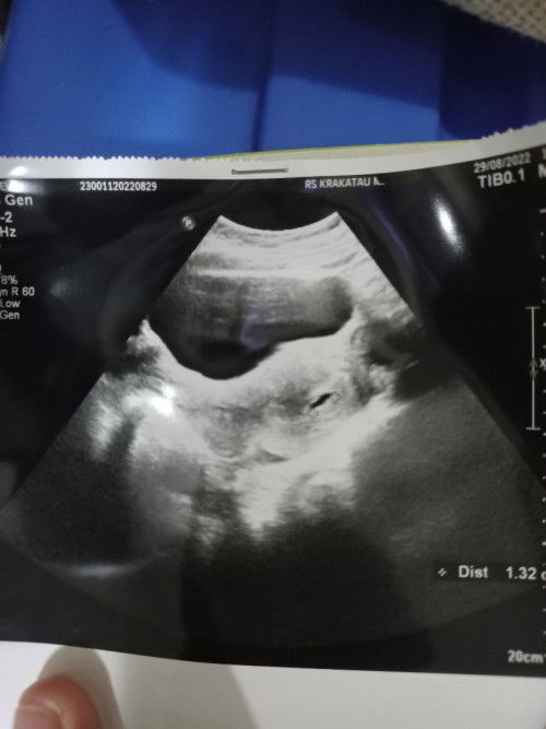 USG 6week, dgn Hpht 15Juli ada yg sama?