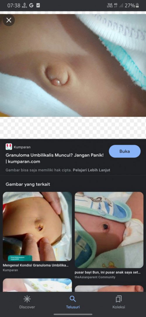 Bund adakah yang sama bayi nya punya dahing kecil di pusar seperti ini.adakah solusinya