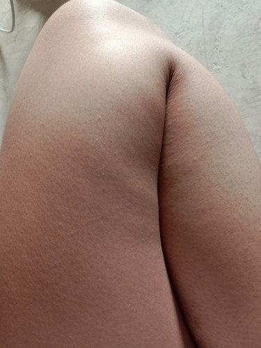 ผื่นขึ้นแบบนี้เป็นไรไหม... ??