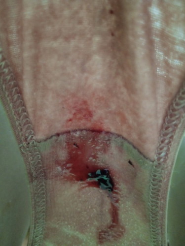 Watery with blood discharge
