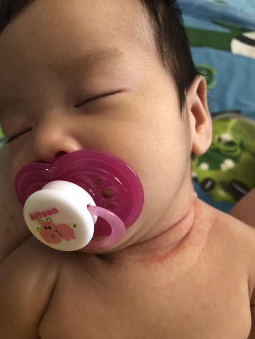 ลูกเป็นผื่นที่คอแดงแสบมีกลิ่น แม่พยายามทำให้คอน้องเเห้งแม่ๆมีวิธีทำให้คอน้องหายมั้ยค่ะ ทรมานใจแม่มากเลยค่ะ