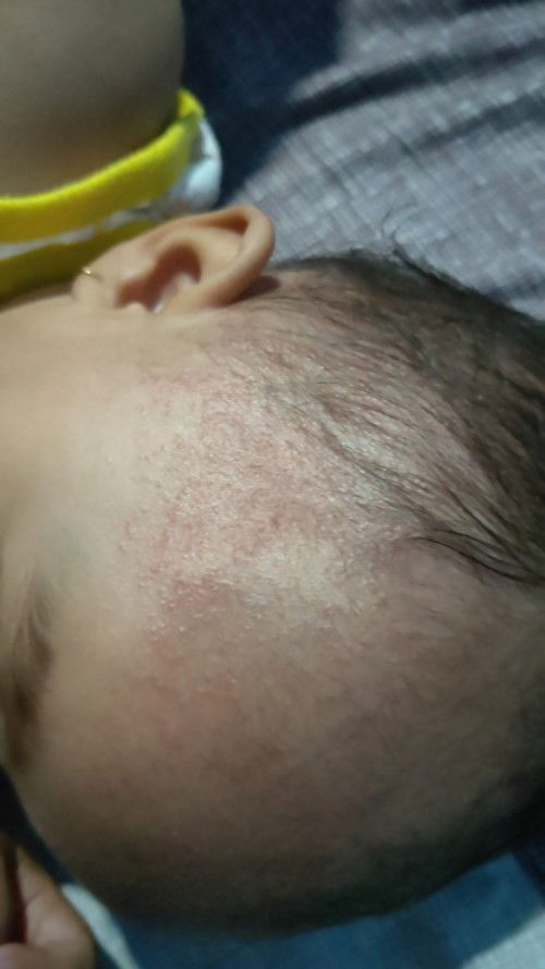 biang keringat pake apa ya