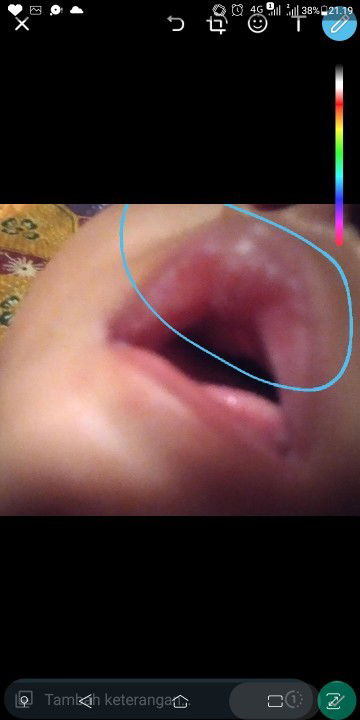 Bibir anakku kaya lebih merah gitu diantara bibir sekitarnya, mohon info dan sarannya bun