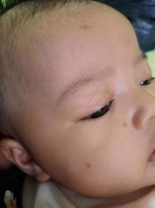 Bintik merah di wajah bayi