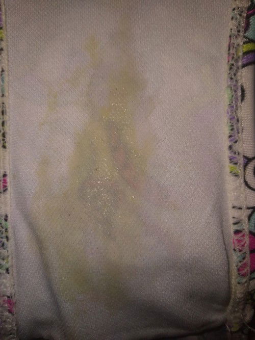 Normal lng ba ang discharge na ganto sa bagong panganak?