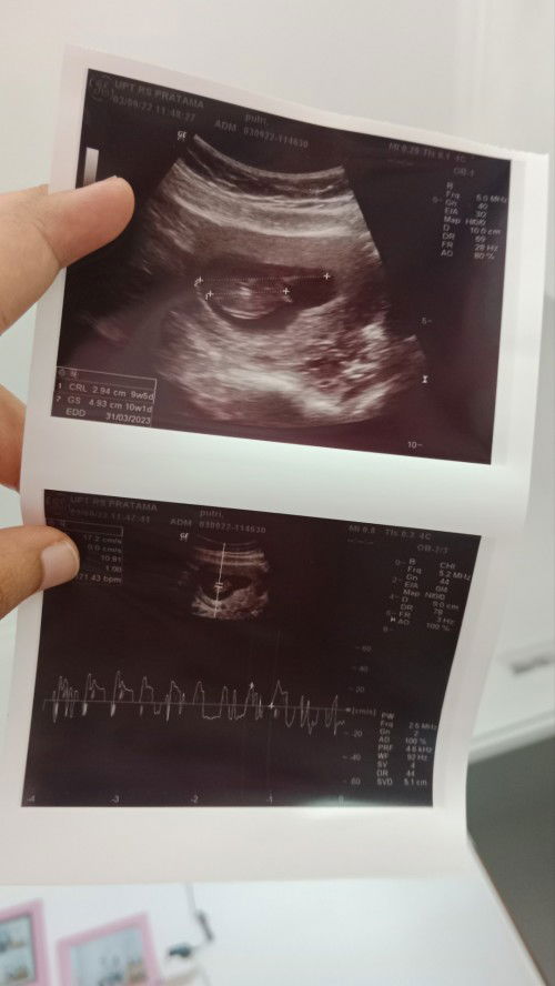 KELANJUTAN POSTINGAN SAYA TENTANG JANIN YANG BELUM TERLIHAT DI 7 WEEK, BO ATAU TIDAK ? INI HASILNYA