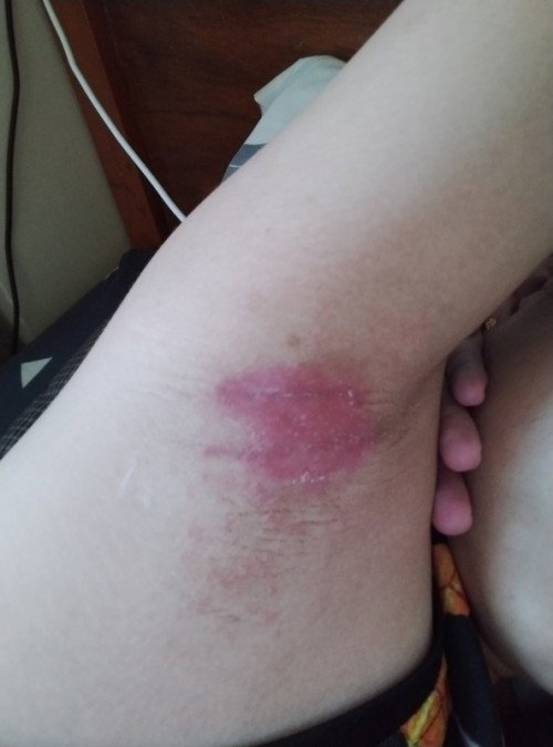 Sugat sa kili kili
2 weeks Post CS