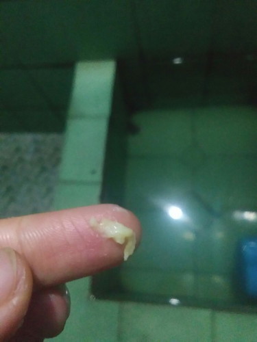 Keputihan berwarna kuning..tekstur kental & tidak berbau
