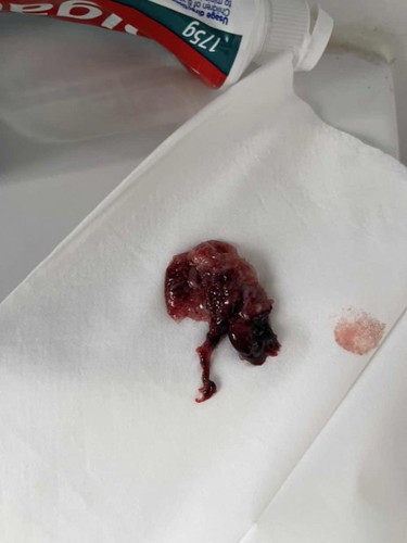 Miscarriage?