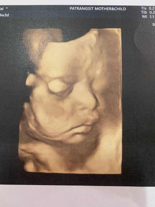 อายุครรภ์29w3d กังวลเรื่องหัวลูกมีขนาดเล็ก
