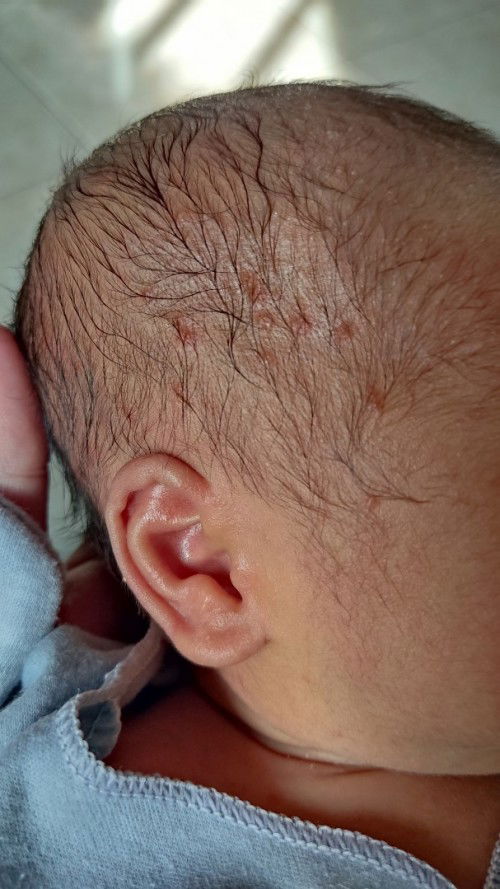 Bintik merah dan biang keringat