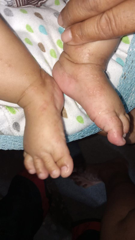Selamat siang moms, mau tanya dong ini kaki anak saya bintik2 gatal bgtu krna apa ya? Apa krna susu?