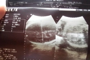 Normal Po ba pag ganito Ang ultrasound?