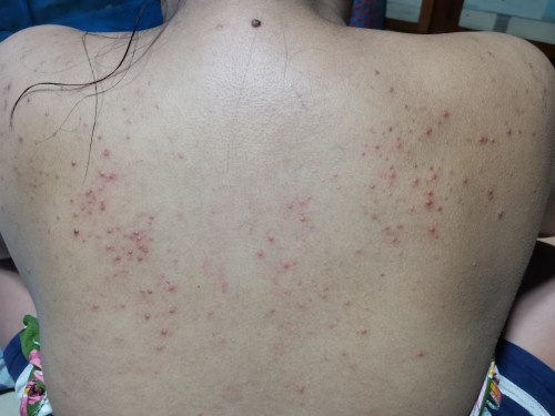Ano po ang gamot nito mga mommies?