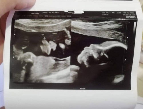 Congenital Anomaly Scan at 24 Weeks.