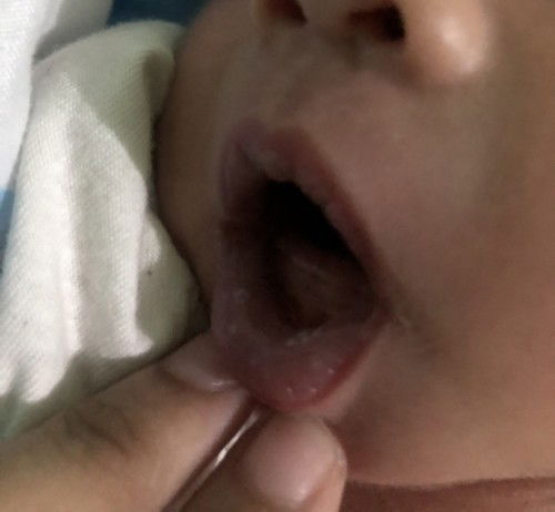 White sa Bibig at Dila