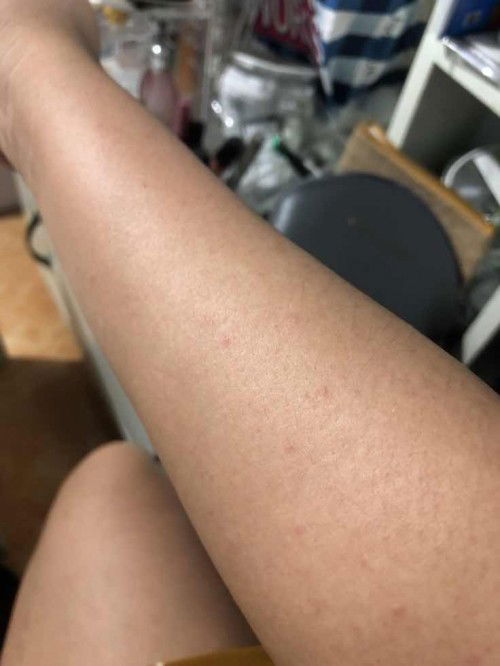 Muncul bintik bintik si tangan dan kaki dan rasanya gatal tak tertahankan