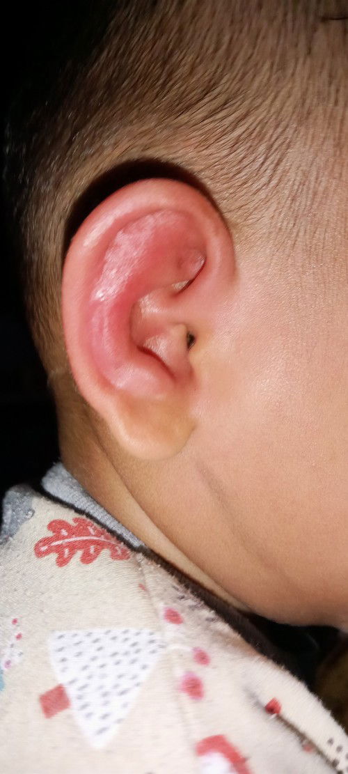Telinga anak merah bengkak