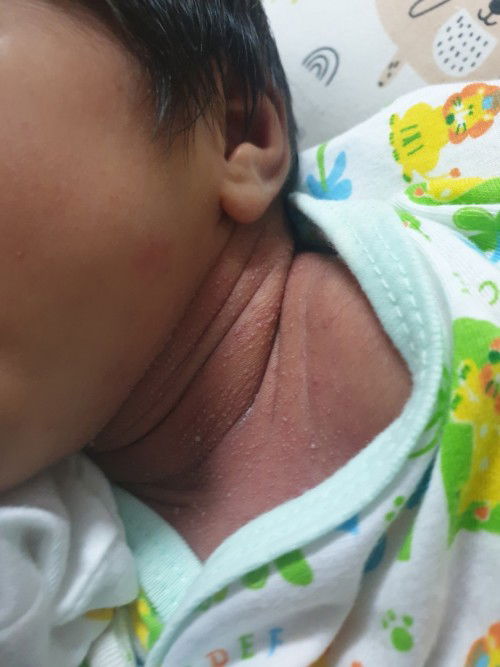 ผดผื่นแบบนี้เรียกว่าผื่นอะไรคะ