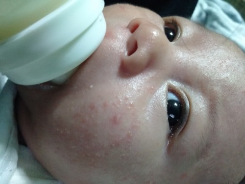 Ano pong pwedwng cure sa baby na may rashes na mukha?