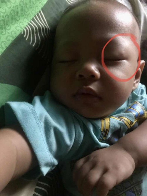 Benjolan di kelopak mata