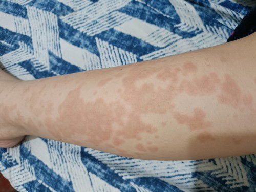 Skin rashes after giving birth (CS DELIVERY) puppp or singaw?