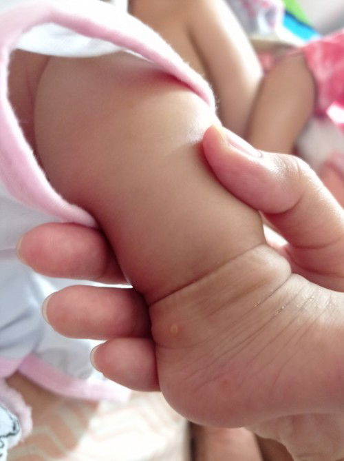 Hello, ano po kaya itong tumubo sa paa ng baby ko na butlig na may tubig? Harmful po ba ito?