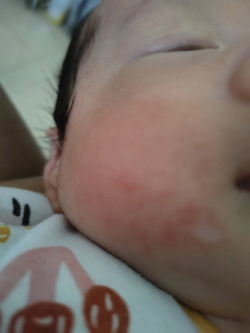 Nanya ruam pada wajah bayi pakai obat apa