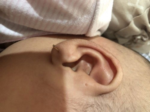 SINUS PREAURICULAR