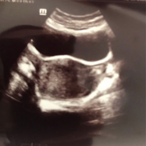 7 week penebalan rahim