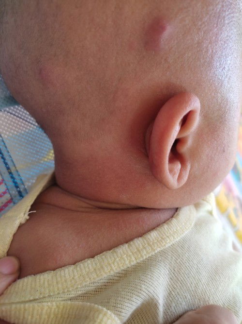 Biang keringat yang tak kunjung sembuh