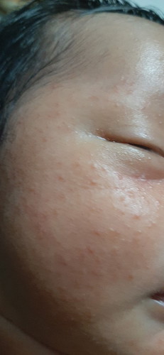 Bagaimana cara mengatasi saraf yang keluar pada kulit bayi
