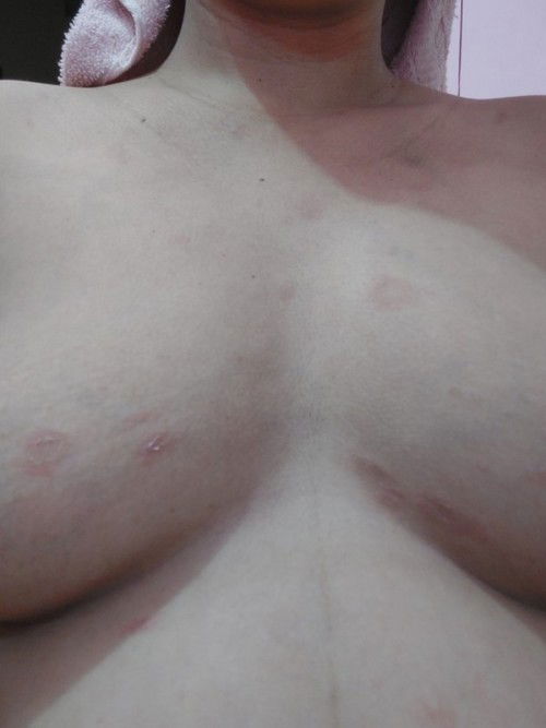 Kati kati or echzema?