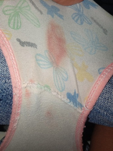 Ako ay first tyme mom 4 Months napo ako may dugo sa stain ng underware ko normal poba ?