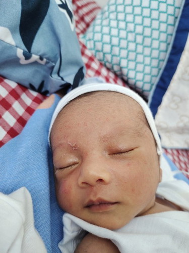 Ano po gamot sa baby acne? nagdikit na po kasi ung acne nya sa kilay banda, dko alam if normal b ito