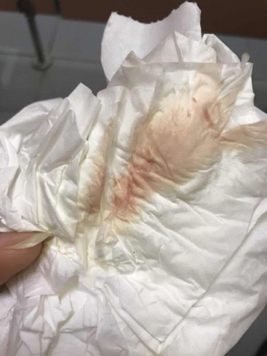 7w2d  เลือดไหล