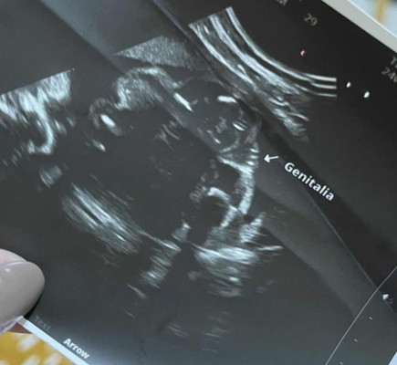 GENDER
Hi mommies! Ask ko lang if sure na BABY GIRL ito? Di ko kasi magets yung scan.