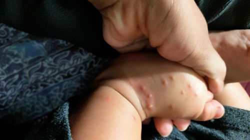 Bentol berair pada bayi