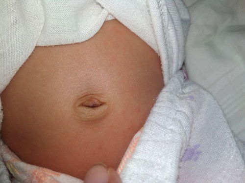 Pusod ( 15 days old bb )