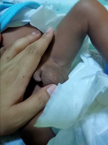 hello, ftm here sa baby boy, tanong lang kung normal ba to? isang malaki at isang maliit?