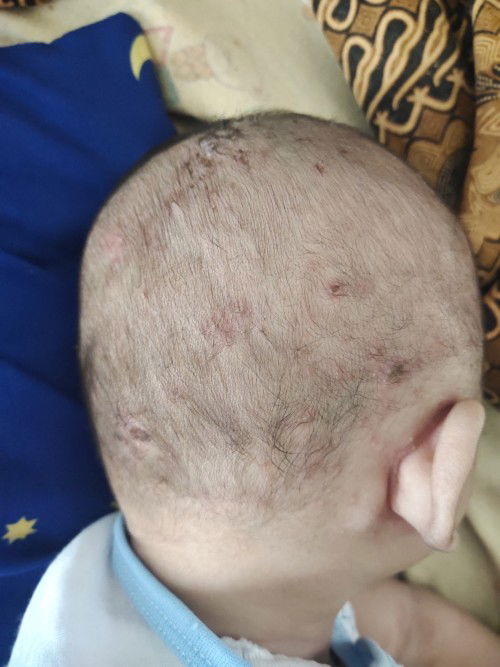 Tumbuh bentol berair di kepala bayi usia 4 bulan