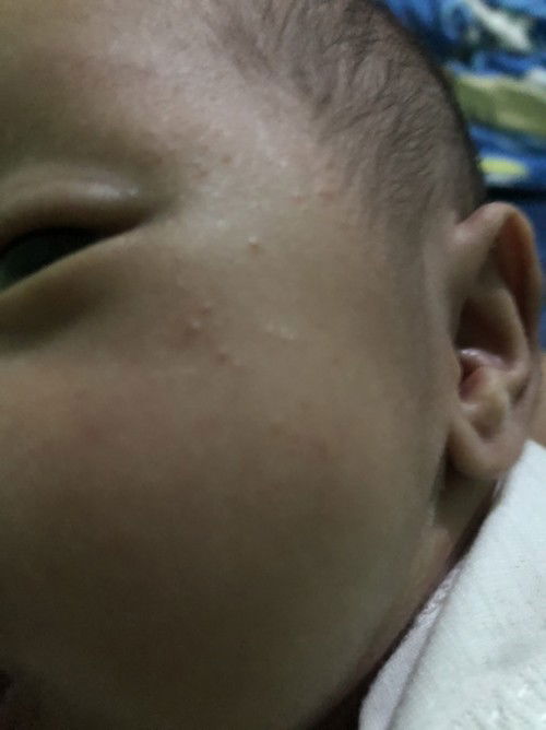 Butlig sa muka ni Baby