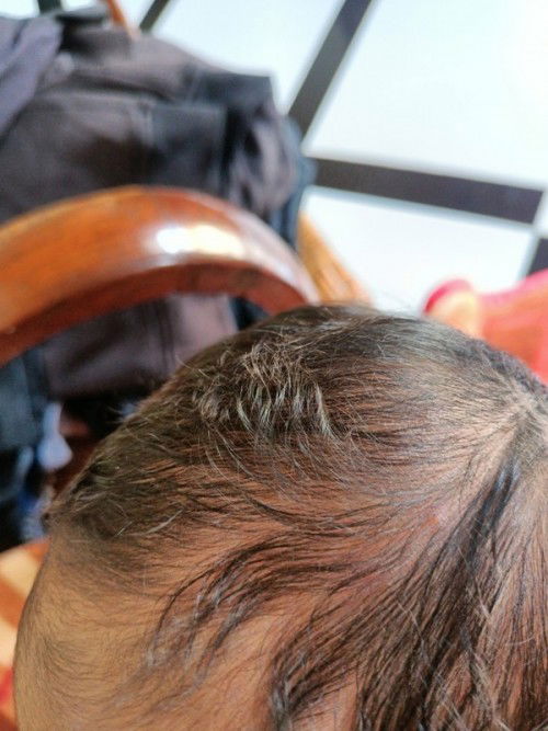 Benjolan seperti jerawat dikepala