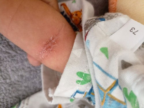 ทาครีมตัวไหนได้บ้างค่ะ  เป็นผื่นอับ ที่แขนกับคอ เป็นเม็ดๆแล้วมันแตกค่ะ