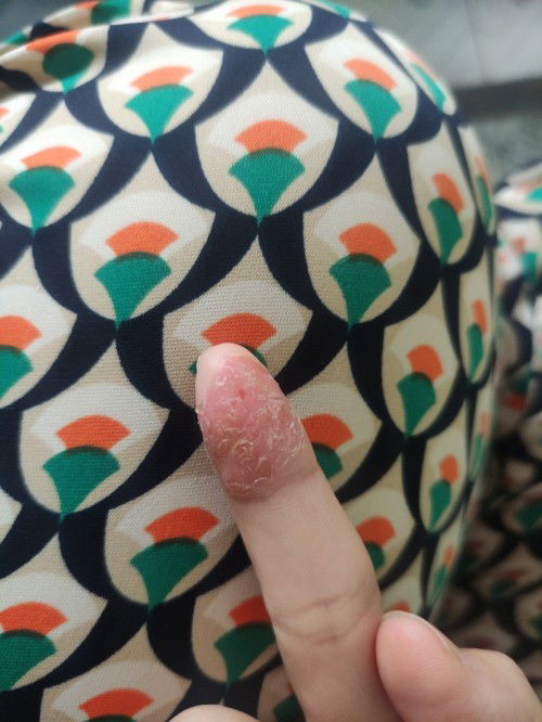 Mẹ bĩm tay bị nước ăn