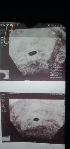 เรานับได้4สัปดา แต่หมอซาวได้5สัปดาค่ะ ผลซาวมีแบบนี้พอมีหวังไหมค่ะ