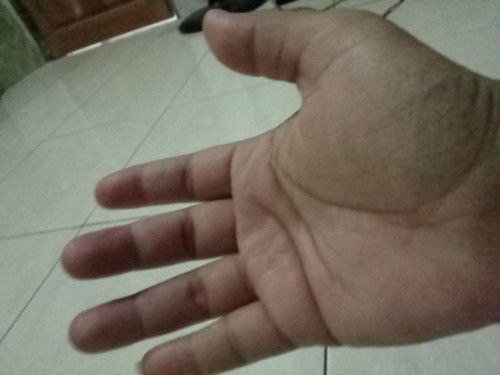 Jari2 tangan kebas/ kesemutan