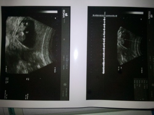 Kehamilan hasil USG