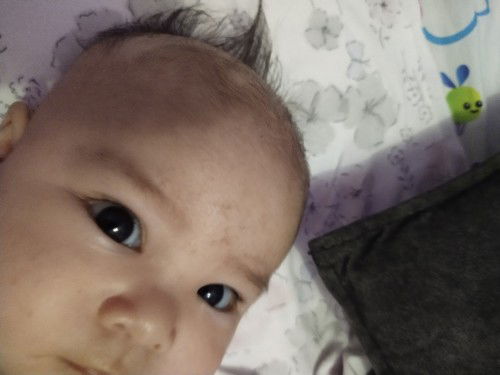 Hi po. Alam niyo po ba pano mawala Ang cradle cap sa face at ulo ni baby?